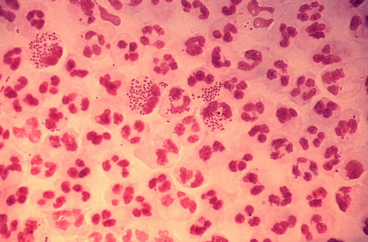 Gonorrhoea STI STD infection