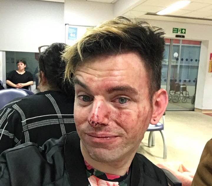 Lee Brobson bravely stood up for his pals before being brutally beaten up by two men. (Facebook)
