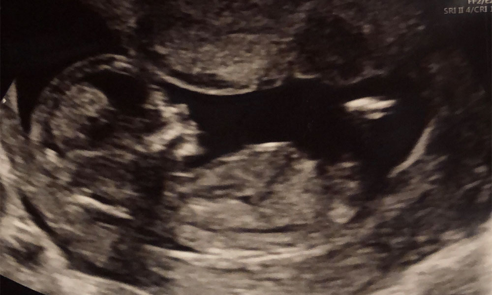 12 week baby scan
