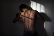 A man's back covered in scars