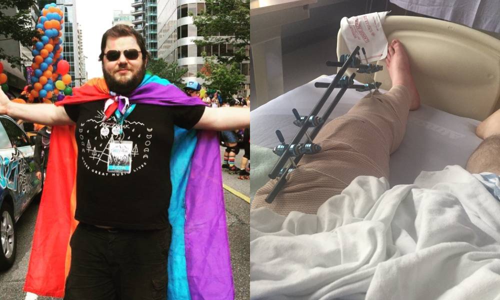 Justin Morissette wearing a rainbow flag as a cape / his leg with metalwork after surgery
