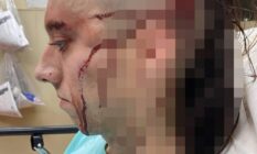 A blurred photo of a woman with a wound to the side of her head