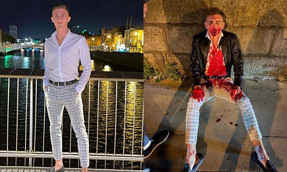 Irish Olympic athlete Jack Woolley before and after the attack