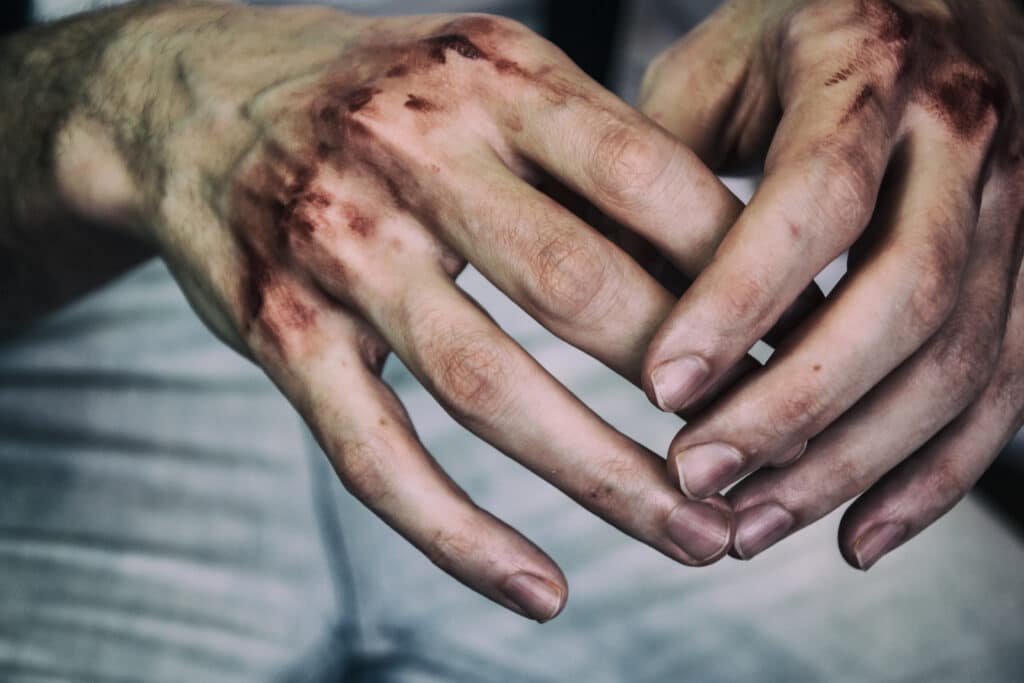 Bruised hands
