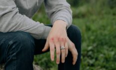 A person who is wearing a grey top and dark bottoms and a ring sits in a grassy area with bruised knuckles