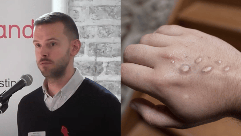 Gay man recalls 'total nightmare' of contracting 'agonising' monkeypox at Pride
