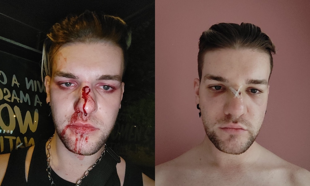 Gay man’s birthday celebrations end with him being brutally beaten on a bus: ‘Justice will happen’