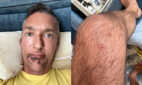 Side by side photo of Silver Steele with lesions under his chin and upper lip and leg
